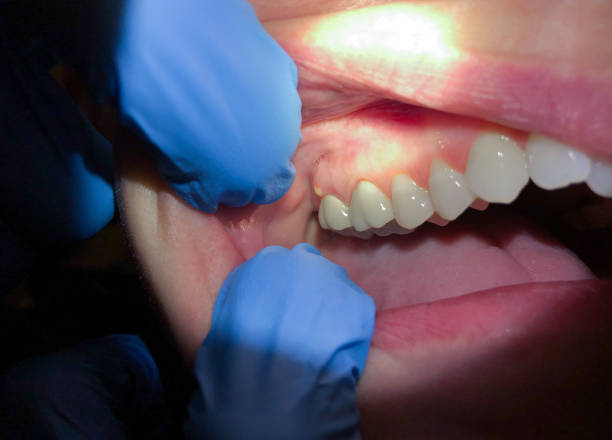 Best Emergency Root Canal Treatment in Birch Run, MI